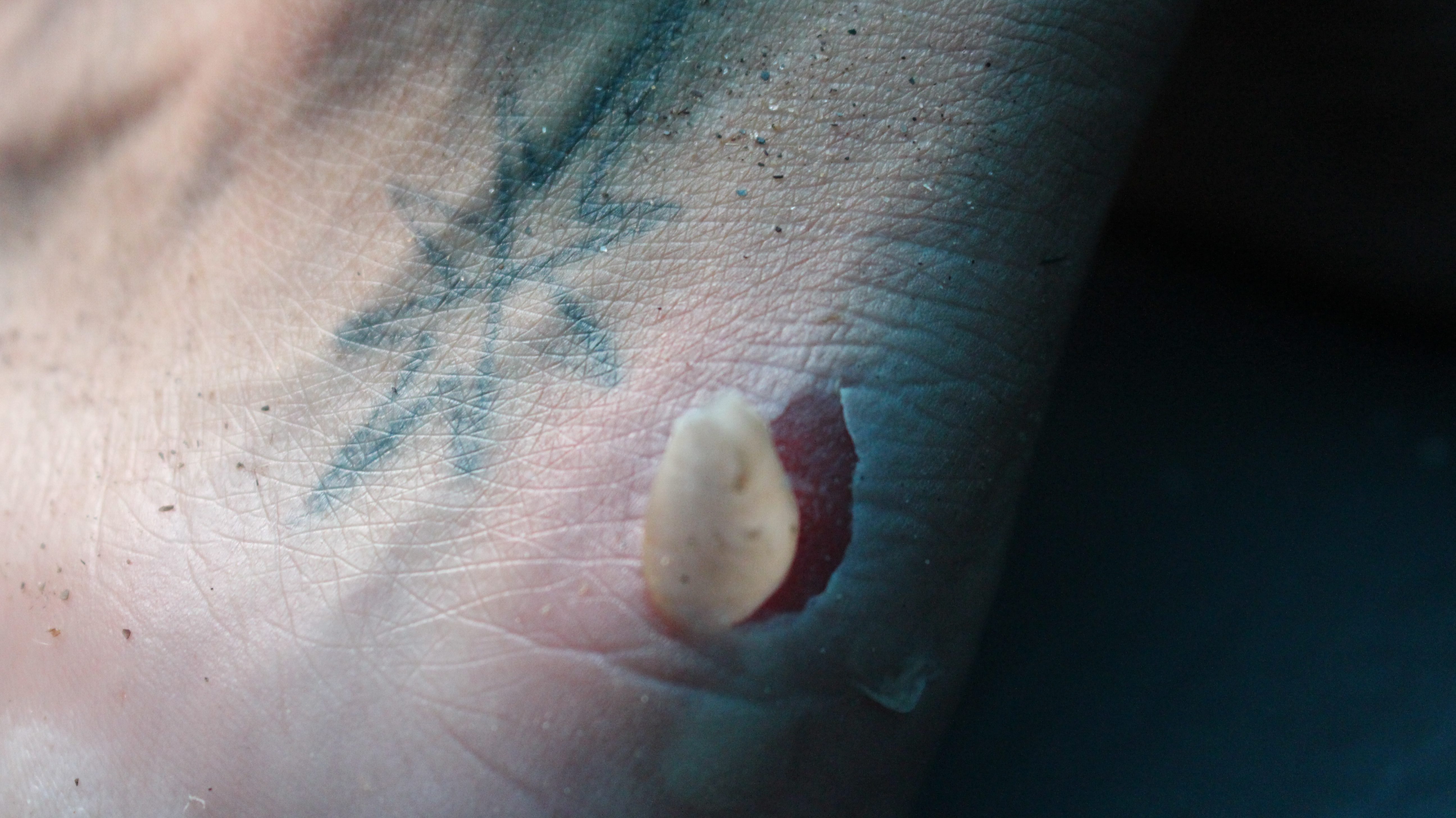 A la fin de la journée, Youri écope d'une jolie ampoule au pied